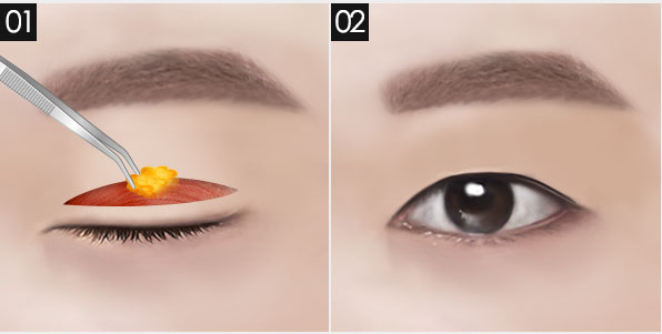 남자 눈 성형, 자연스럽고 또렷한 인상으로! 관련 이미지 4