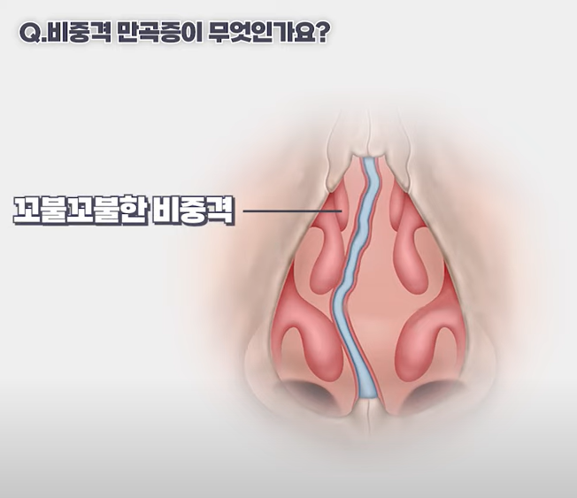 코막힘의 원인! 비중격 만곡증에 대해서 알려드립니다. 관련 이미지 3