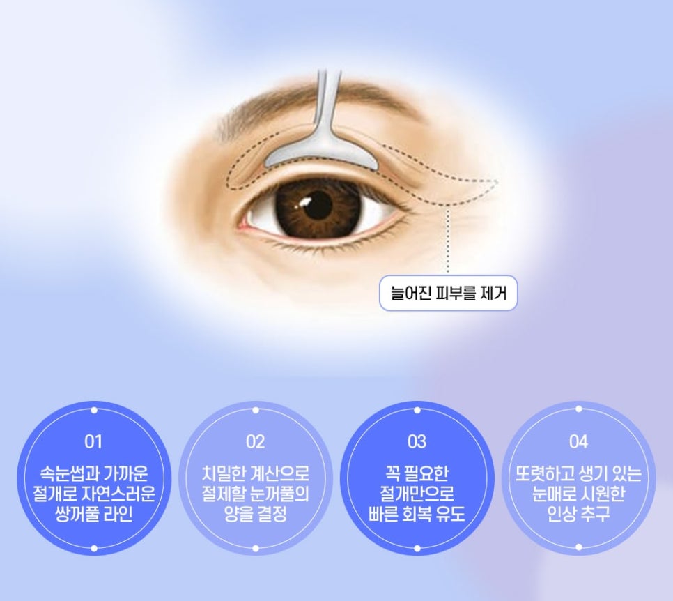 노화로 인한 눈꺼풀 처짐, 비절개 상안검으로 개선할 수 있습니다! 관련 이미지 4