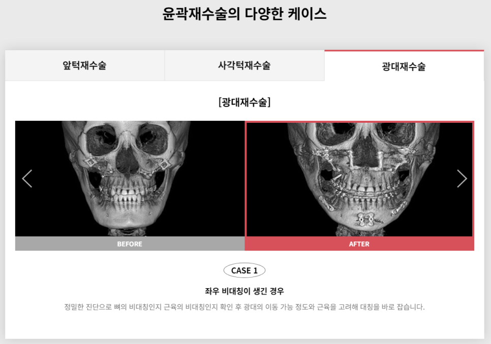 다시 되찾는 아름다운 미소! 윤곽재수술 관련 이미지 7