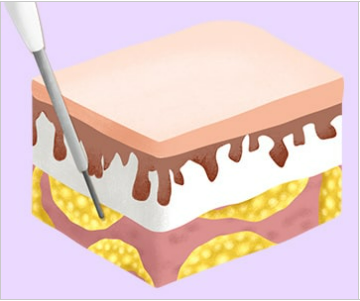 가슴축소수술, 그 이상의 의미 관련 이미지 6