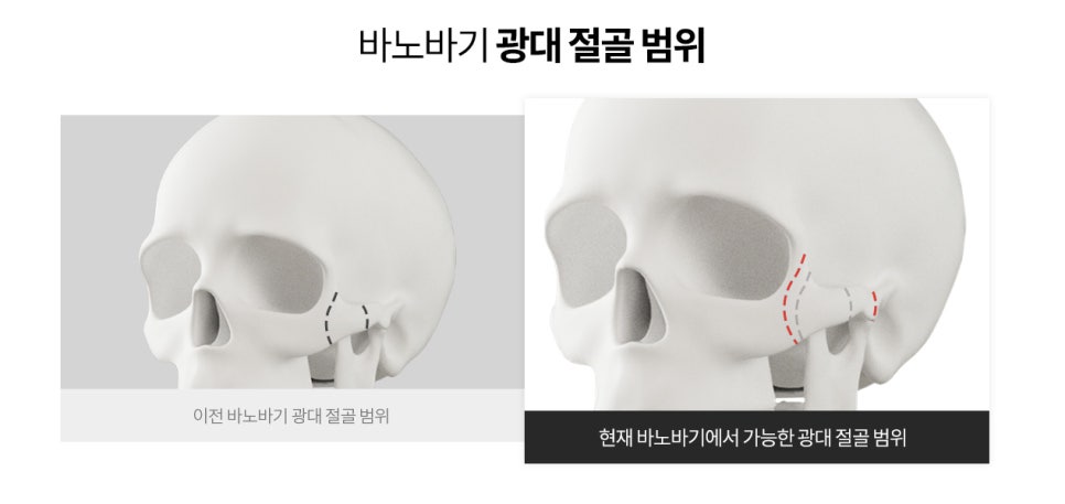 광대 수술 피부 처짐 없이 자연스럽게 개선 가능할까? 관련 이미지 2