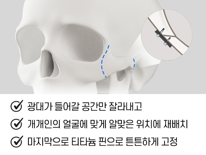 차별화된 방법으로 접근하는 남자 안면윤곽 관련 이미지 8