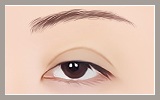 눈 재수술의 다양한 원인과 재수술 방법 관련 이미지 5