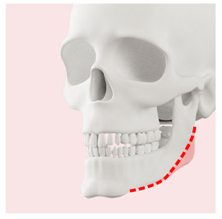 사각턱 수술 방법이 나뉘는 이유와 나에게 맞는 수술법은? 관련 이미지 3