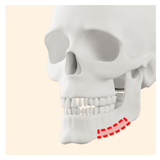 사각턱 수술 방법이 나뉘는 이유와 나에게 맞는 수술법은? 관련 이미지 4