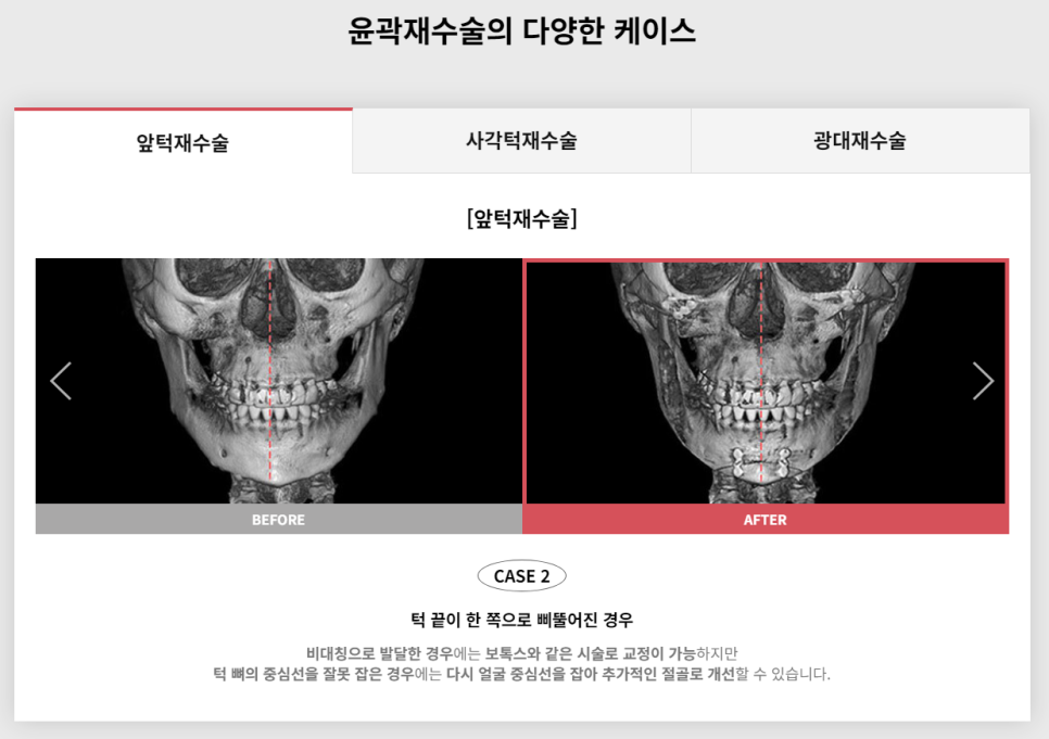 다시 되찾는 아름다운 미소! 윤곽재수술 관련 이미지 3