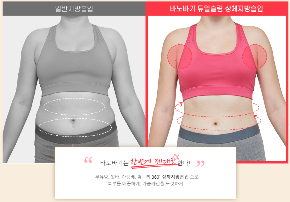 상체 지방흡입과 가슴 축소의 날씬한 조합! 듀얼슬림 관련 이미지 3