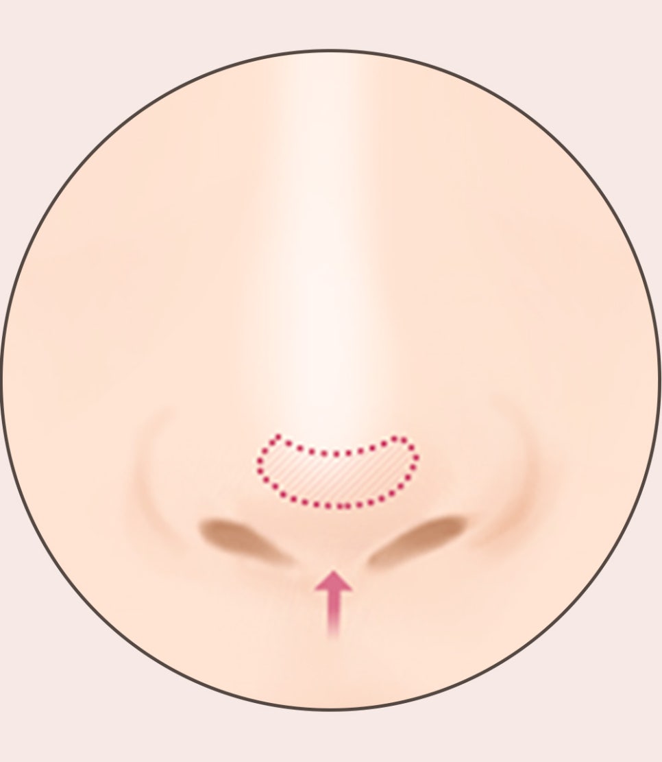 코 재수술의 다양한 원인과 개선 방법! 관련 이미지 13