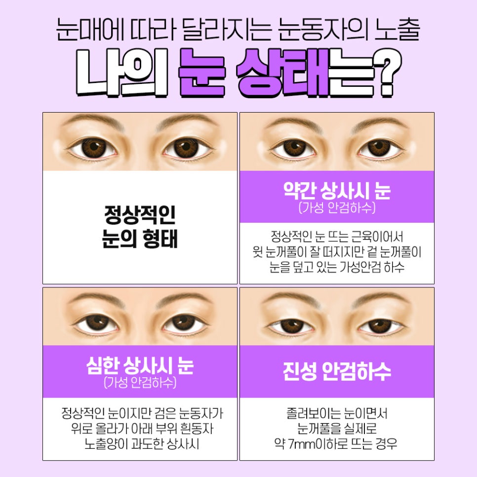눈매교정 나에게 맞는 수술법으로 확실하게 개선하자 관련 이미지 2