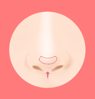 코성형보형물 코재수술 부작용이 있다면? 설명드립니다. 관련 이미지 9
