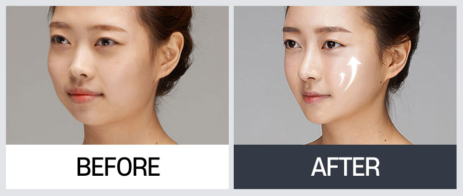 윤곽 재수술의 다양한 케이스와 수술 방법 관련 이미지 9