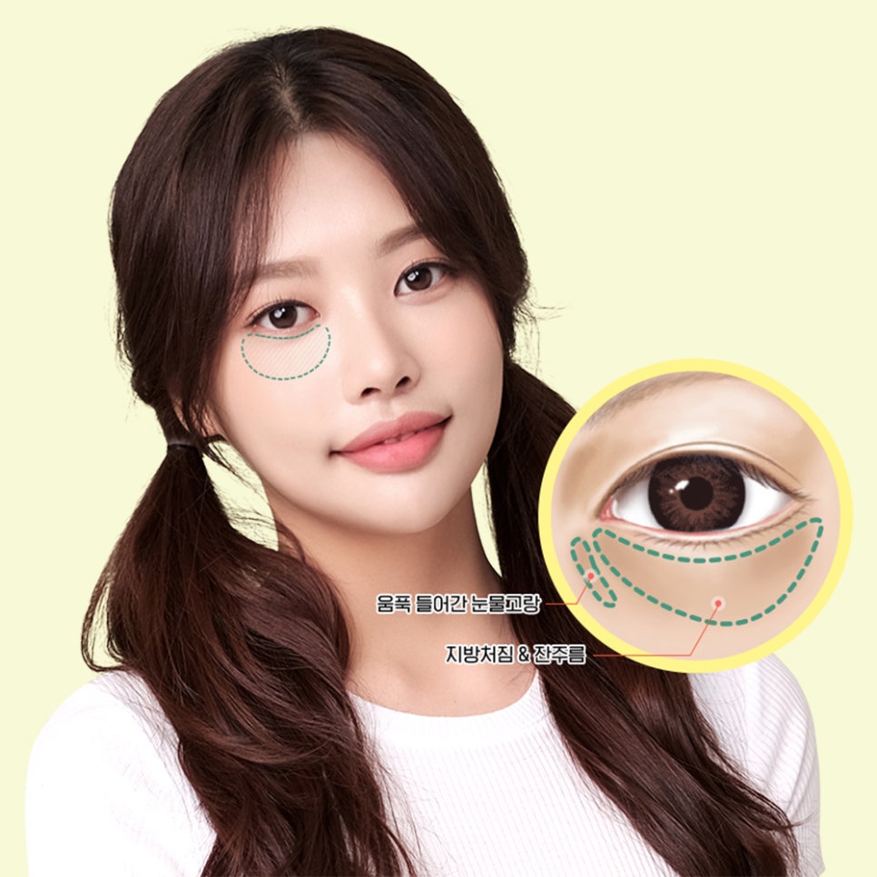 눈 밑 지방재배치로 다크서클, 눈 밑 주름 개선할 수 있습니다. 관련 이미지 2