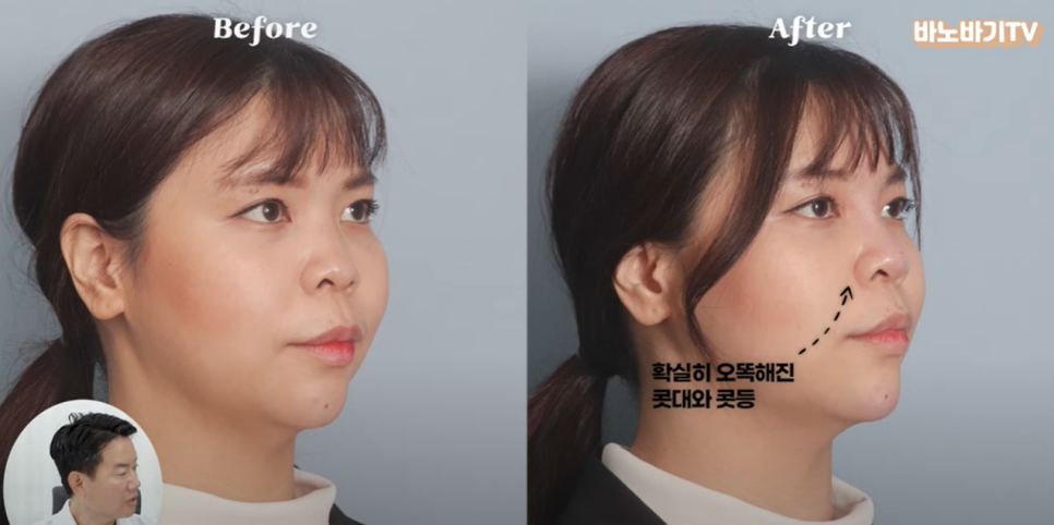 아테콜 필러의 장점과 아테콜 추천 부위는?! 관련 이미지 12