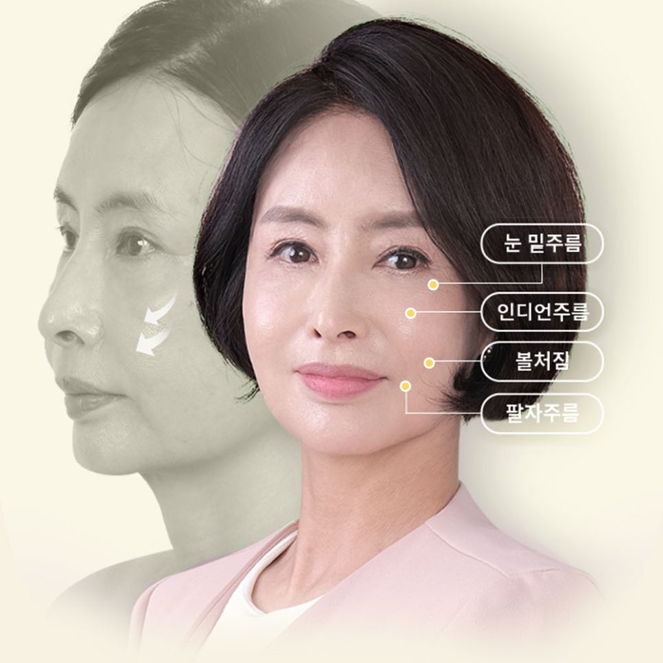 눈 밑, 팔자 주름 동시에 개선하는 중안면부 리프팅 관련 이미지 2