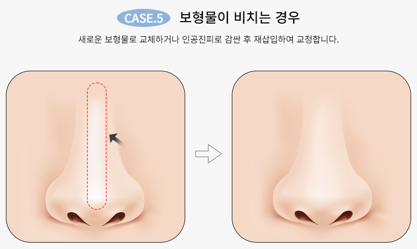 마지막 코재수술, 바노바기에서! 관련 이미지 7