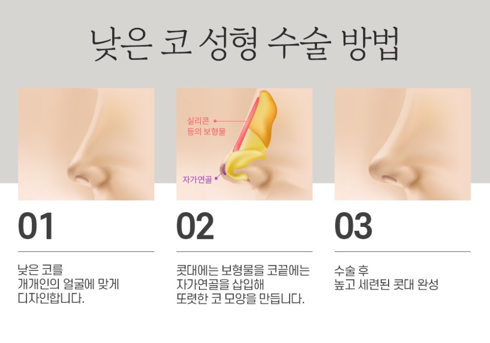 낮은 코 수술, 콧대부터 코끝부터 한 번에 개선 관련 이미지 4