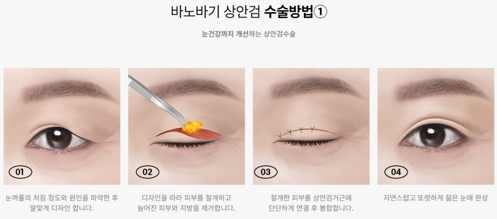 미용적+기능적 문제를 동시에 개선하다, 상안검/하안검 관련 이미지 3