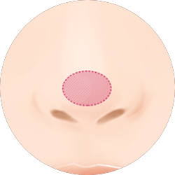 코재수술비용 코재수술병원 바노바기는 제대로 합니다! 관련 이미지 6