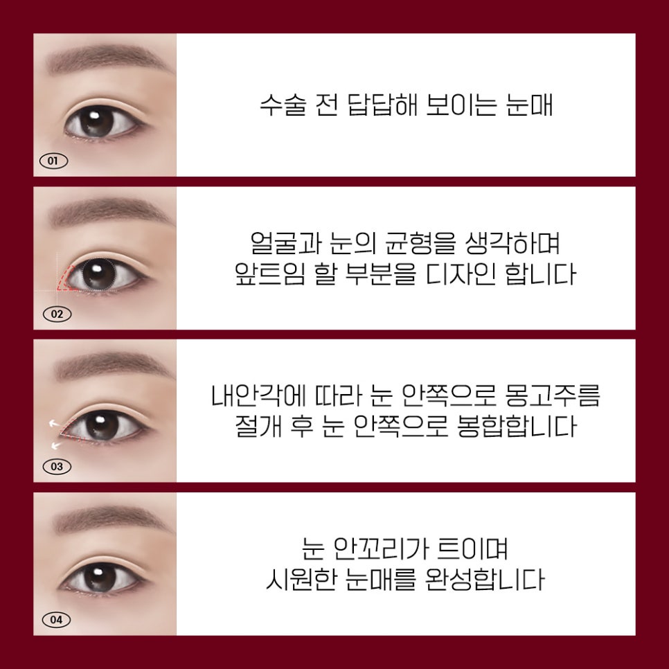 나에게 맞는 트임 성형으로 크고 또렷한 눈매로 개선 관련 이미지 3