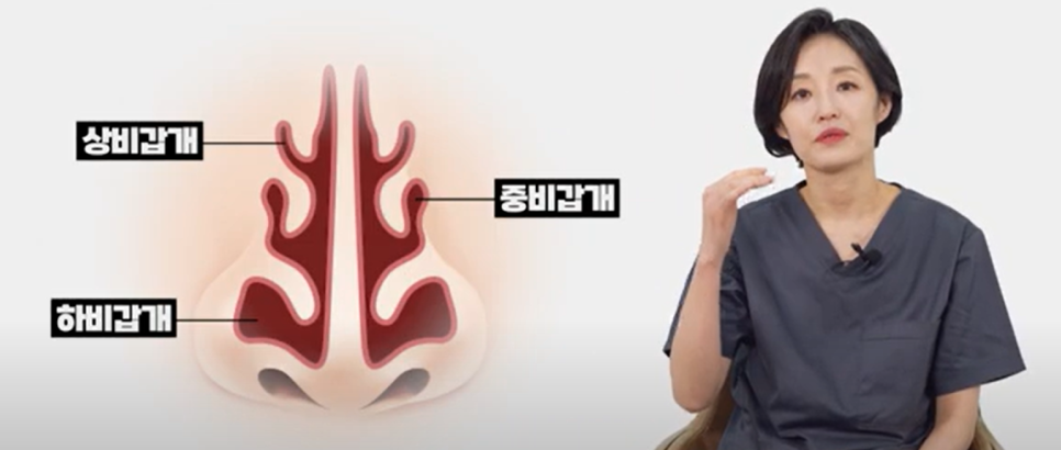 하비갑개 비후증이란?(코막힘, 콧물, 비염의 원인) 관련 이미지 1
