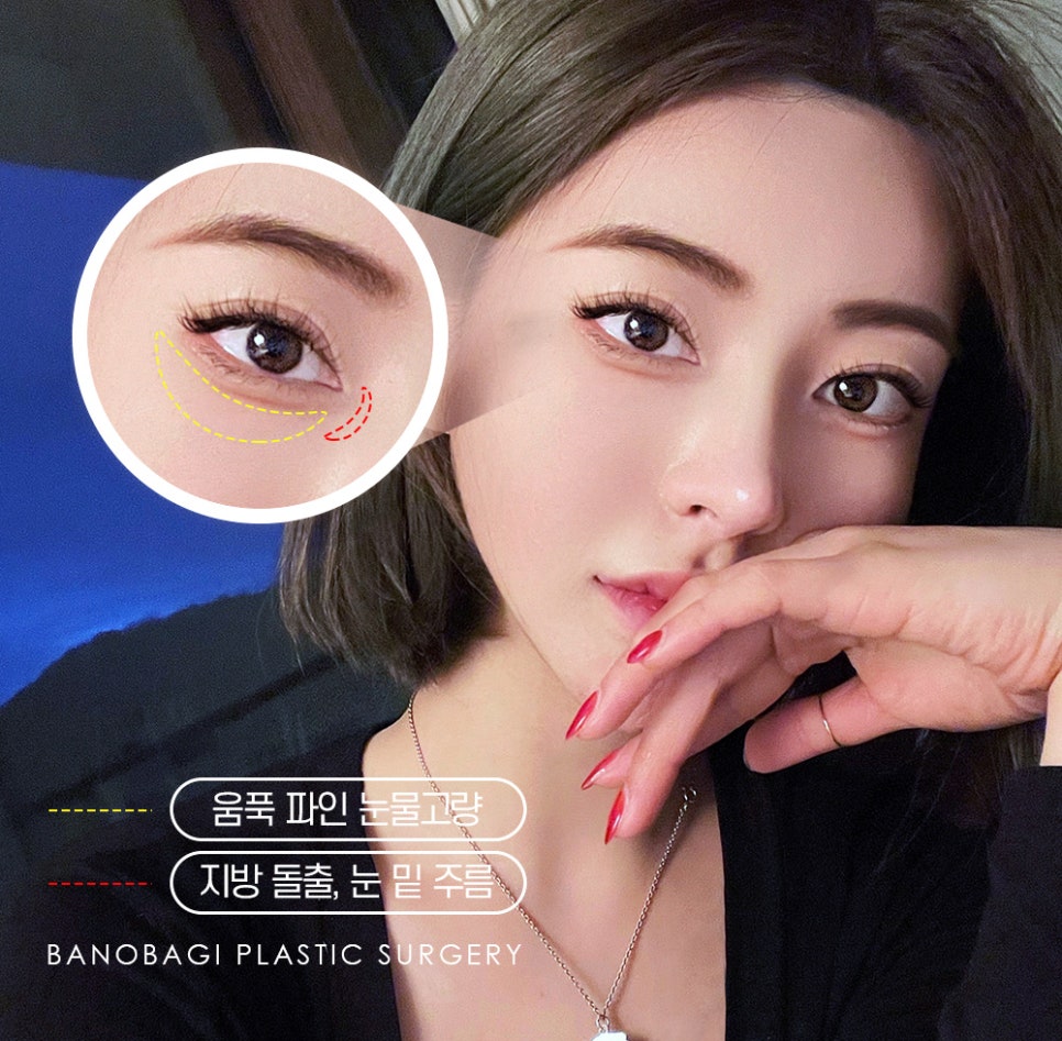 볼록한 눈 밑, 다크서클 한 번에 개선하는 눈밑지방재배치 관련 이미지 2