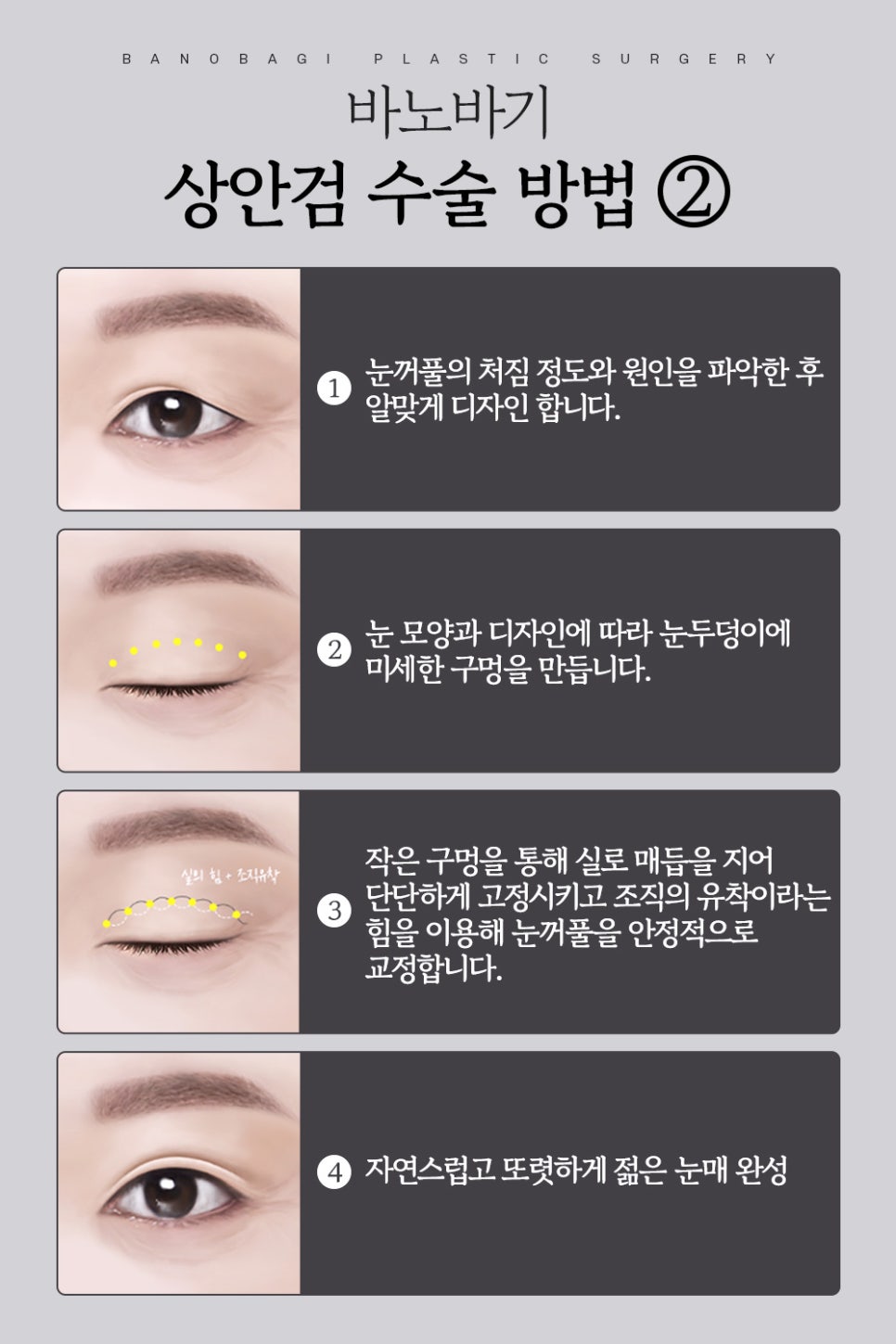 상안검, 미용적 기능적 문제 동시에 개선해 동안 눈매로 관련 이미지 4