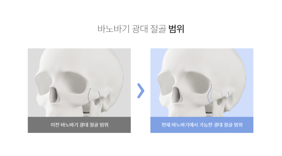 안면 윤곽 기술력의 집약 광대수술 관련 이미지 4