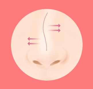 코성형보형물 코재수술 부작용이 있다면? 설명드립니다. 관련 이미지 7