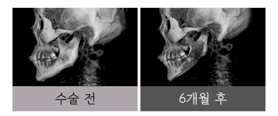 윤곽 재수술, 정밀한 진단과 치밀한 설계로 바로잡아야 합니다. 관련 이미지 2