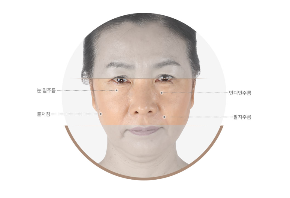 중안면부리프팅 팔자주름을 효과적으로 당기다! 관련 이미지 2