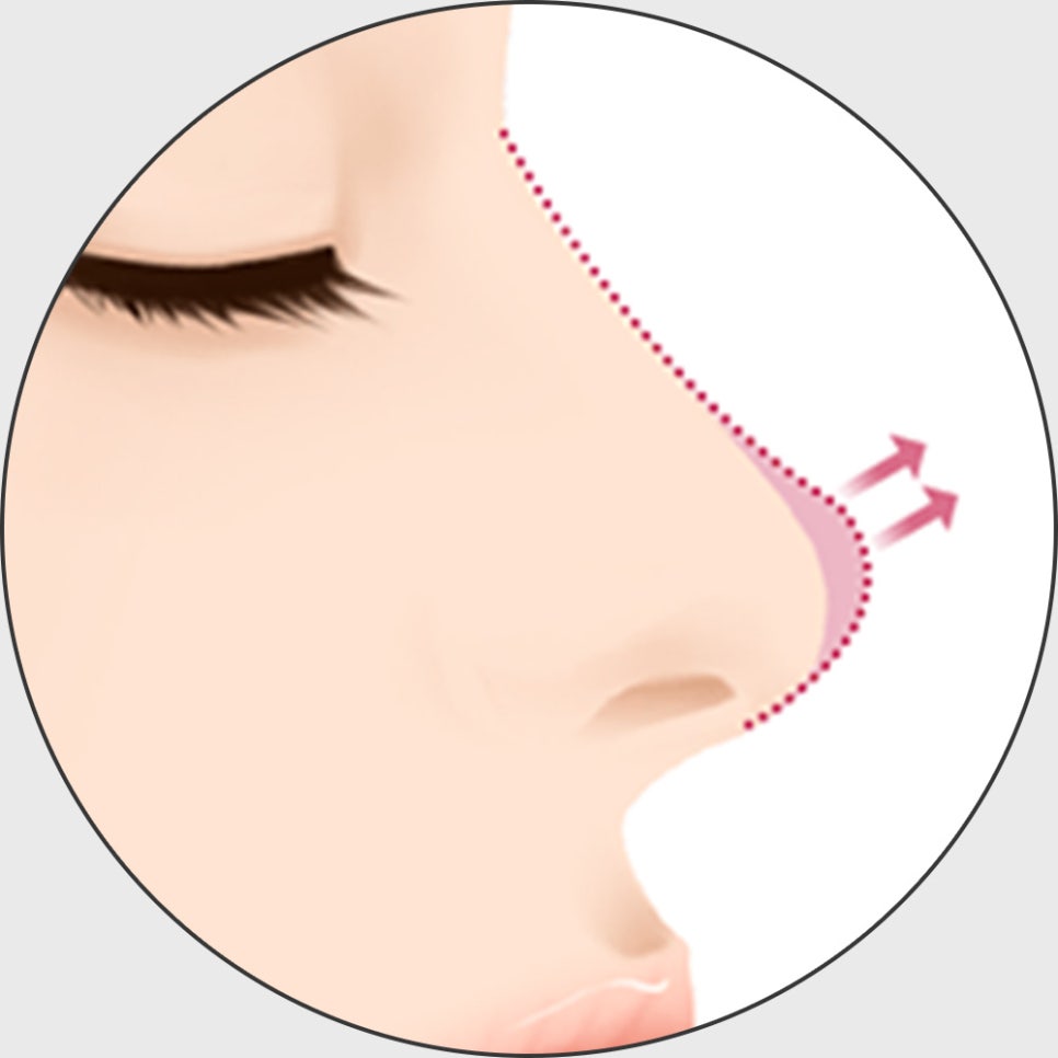 코 재수술, 적합한 시기에 원인에 따른 올바른 방법으로 개선해야 합니다! 관련 이미지 3