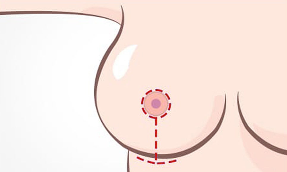 처진 가슴, 케이스에 따른 맞춤 개선으로 탄력 있고 볼륨감 있는 가슴으로! 관련 이미지 5