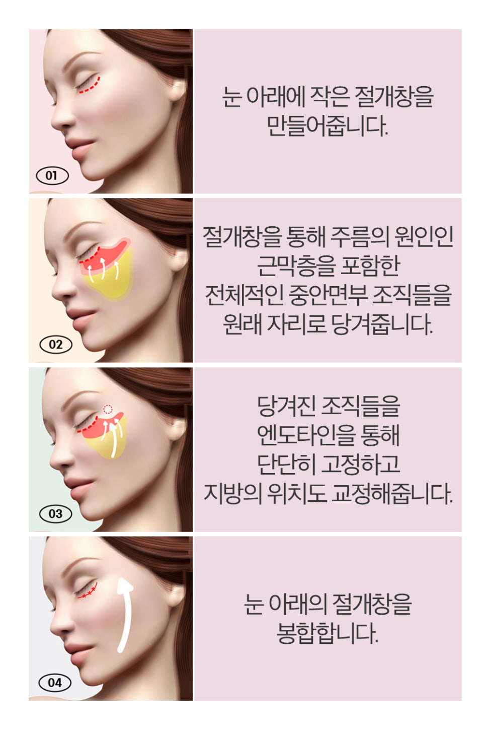 중안면부 리프팅 수술법과 엔도타인의 장점 관련 이미지 4