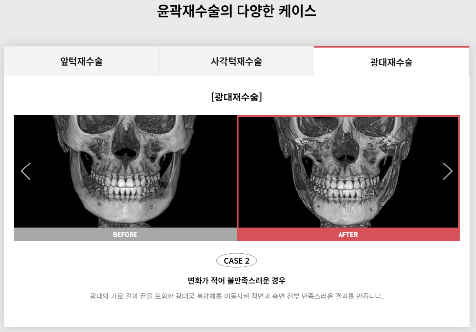 다시 되찾는 아름다운 미소! 윤곽재수술 관련 이미지 8