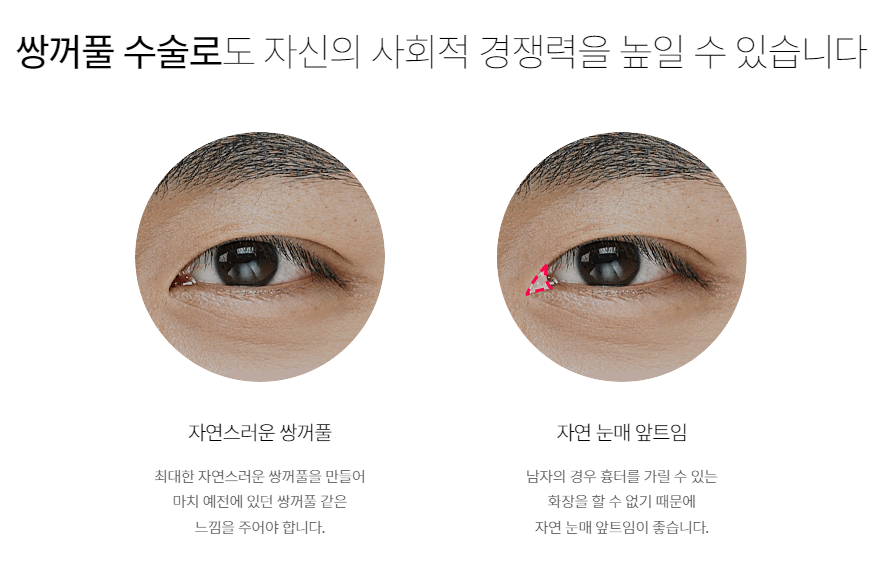 자연스러운 남자 눈매, 바노바기 남자 쌍꺼풀! 관련 이미지 3