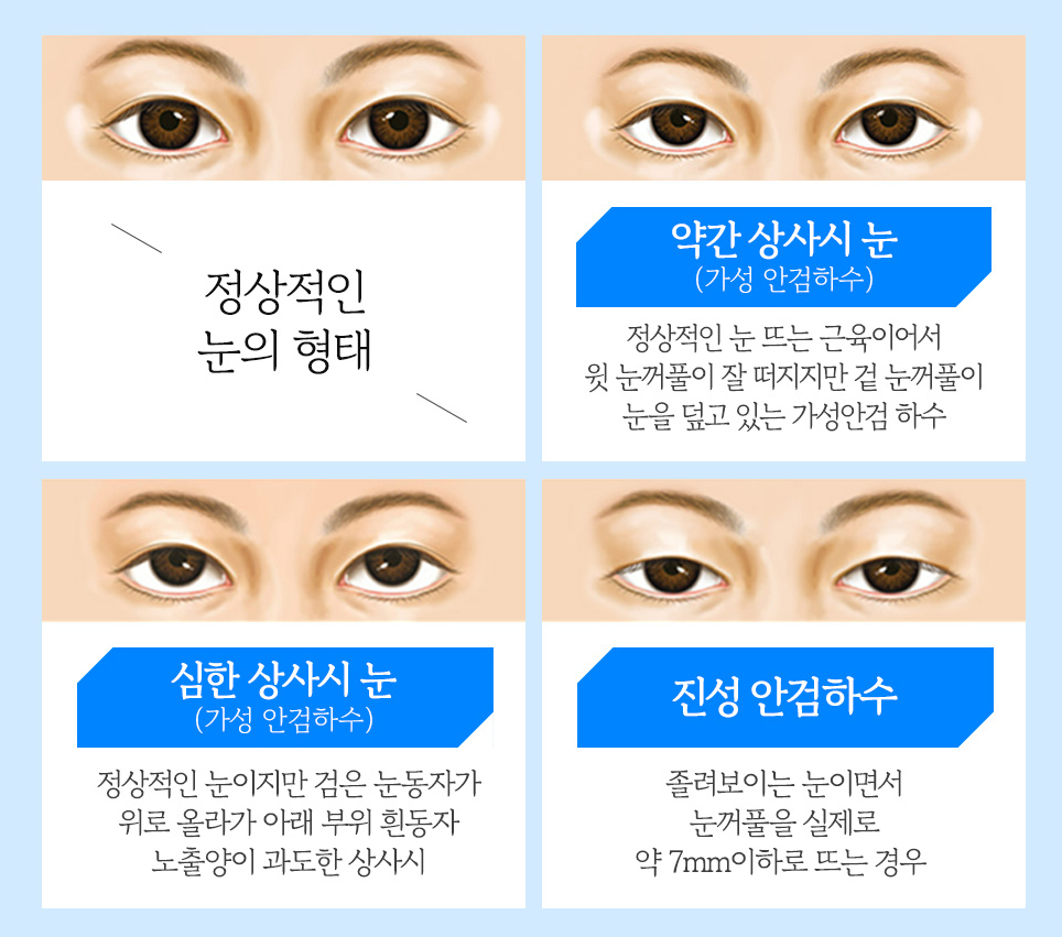 남자 눈 성형, 자연스럽고 매력적인 눈매로 개선 관련 이미지 3