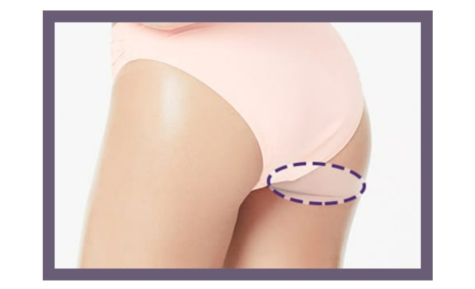 유방암 치료 후 가슴 재건 시기와 수술 방법 관련 이미지 9