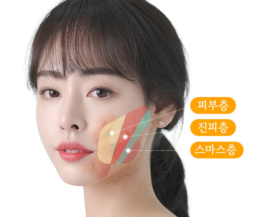 뼈 수술 없이 얼굴형 개선이 가능한 바노바기 미니V리프팅 관련 이미지 5