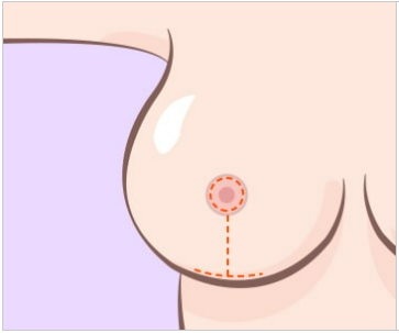 가슴축소수술, 그 이상의 의미 관련 이미지 5