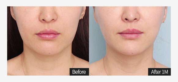 이중턱지방흡입과 민트실리프팅을 한번에 하면 그 효과는? 관련 이미지 5