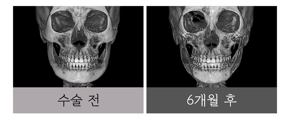 윤곽 재수술, 정밀한 진단과 치밀한 설계로 바로잡아야 합니다. 관련 이미지 6