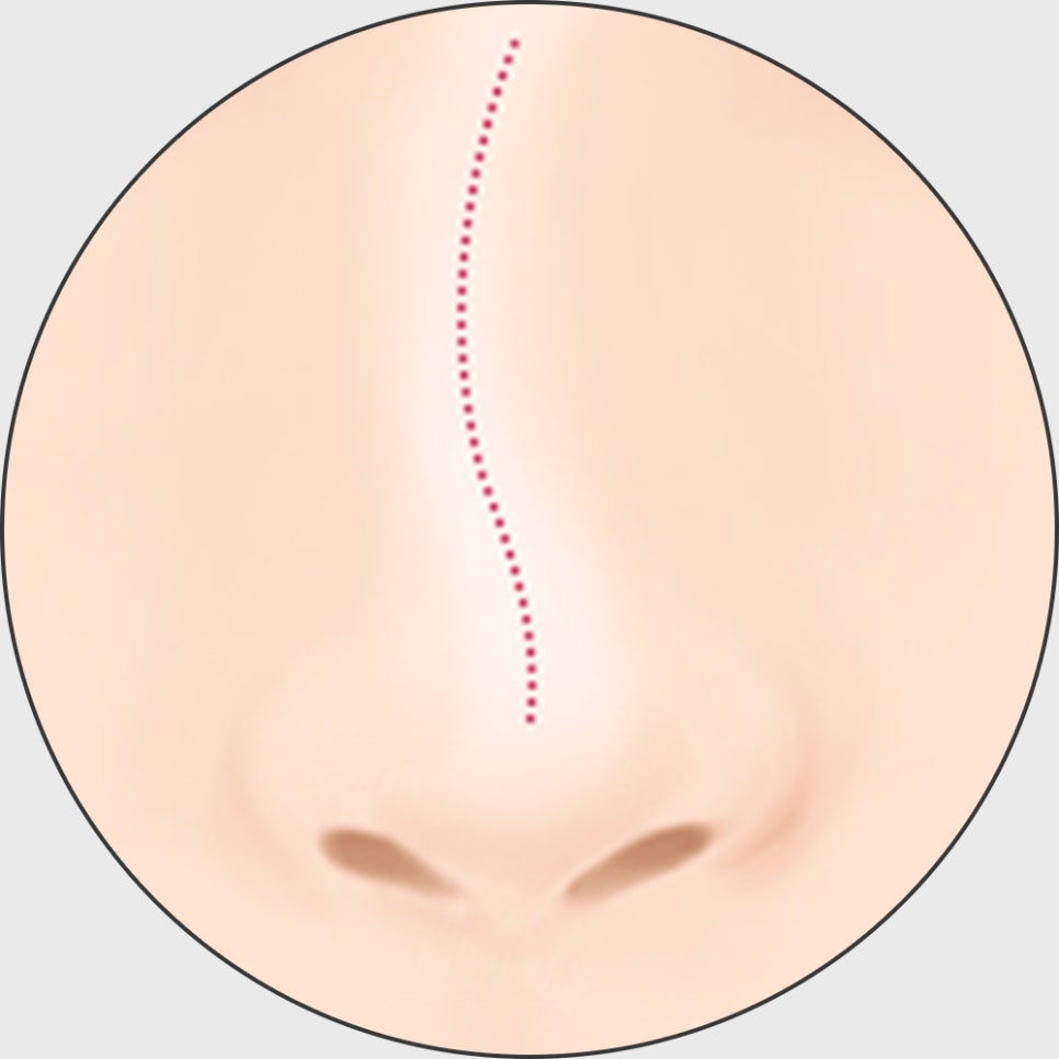 코 재수술, 적합한 시기에 원인에 따른 올바른 방법으로 개선해야 합니다! 관련 이미지 7