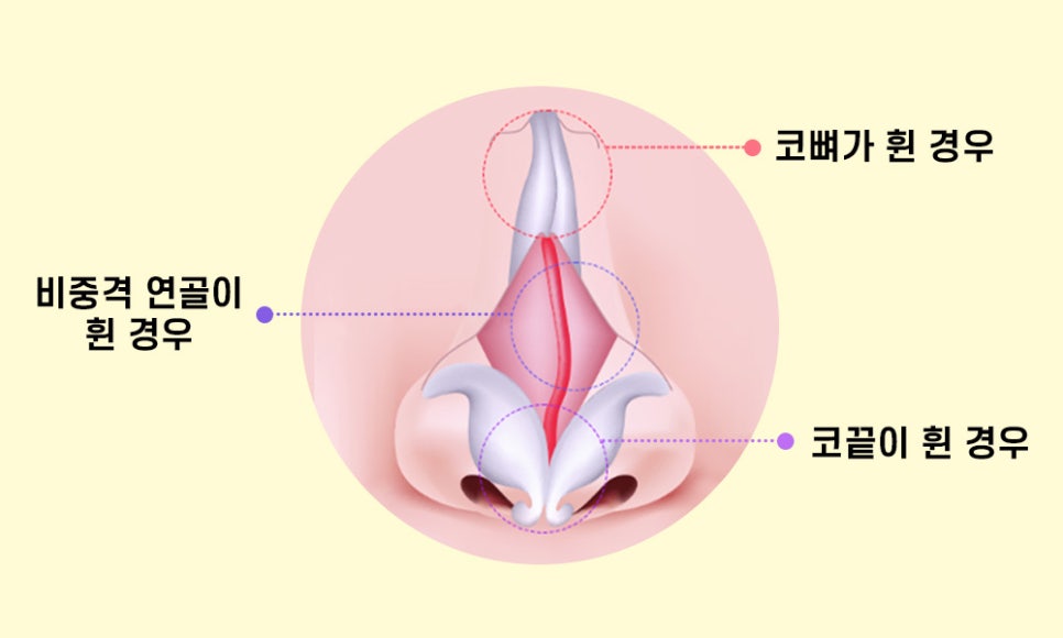 휘어진 콧대와 코 속을 한 번에 바로잡는 휜코 성형 관련 이미지 2