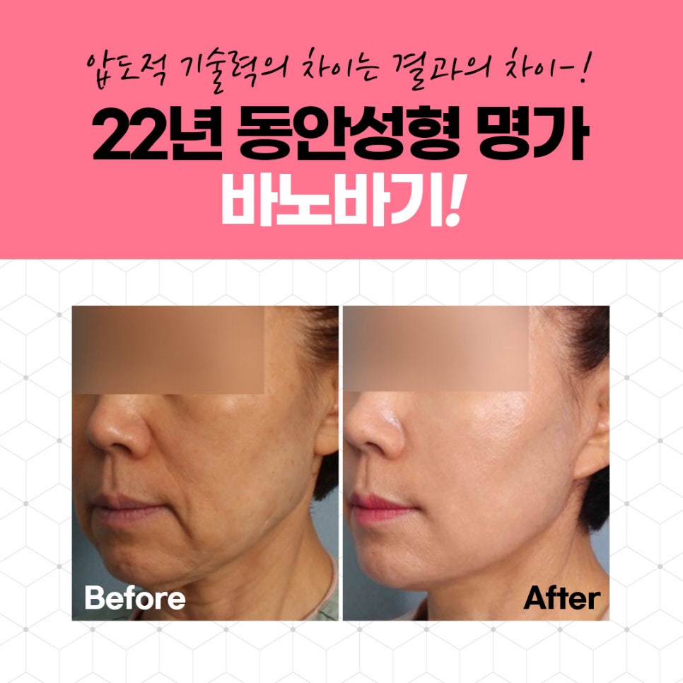 바노바기 탄력 리프팅이란? 관련 이미지 1