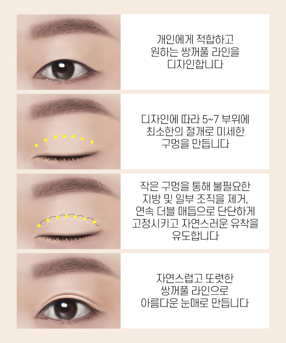 이중 매몰법의 장점과 기존 매몰법과의 차이점 관련 이미지 2