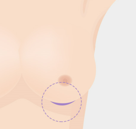 가슴 확대술, 최적의 보형물로 아름다운 가슴 형태를 만들어야 합니다. 관련 이미지 7
