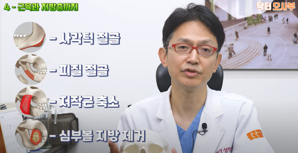 나에게 맞는 사각 턱 수술로 각진 턱과 넓은 얼굴을 개선하자! 관련 이미지 6