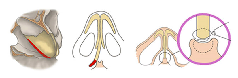 남자에게 맞는 코 성형과 개선 방법! 관련 이미지 9