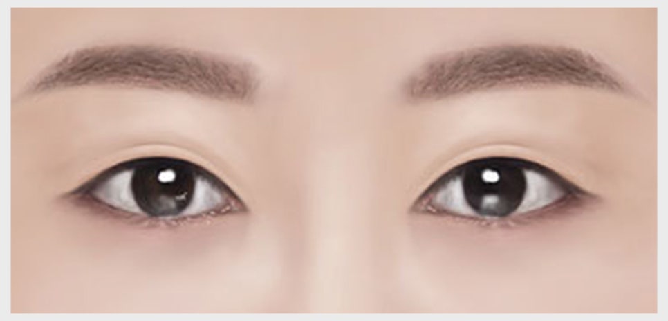 쌍꺼풀 재수술이 필요한 유형과 원인에 맞는 재수술 방법 관련 이미지 4